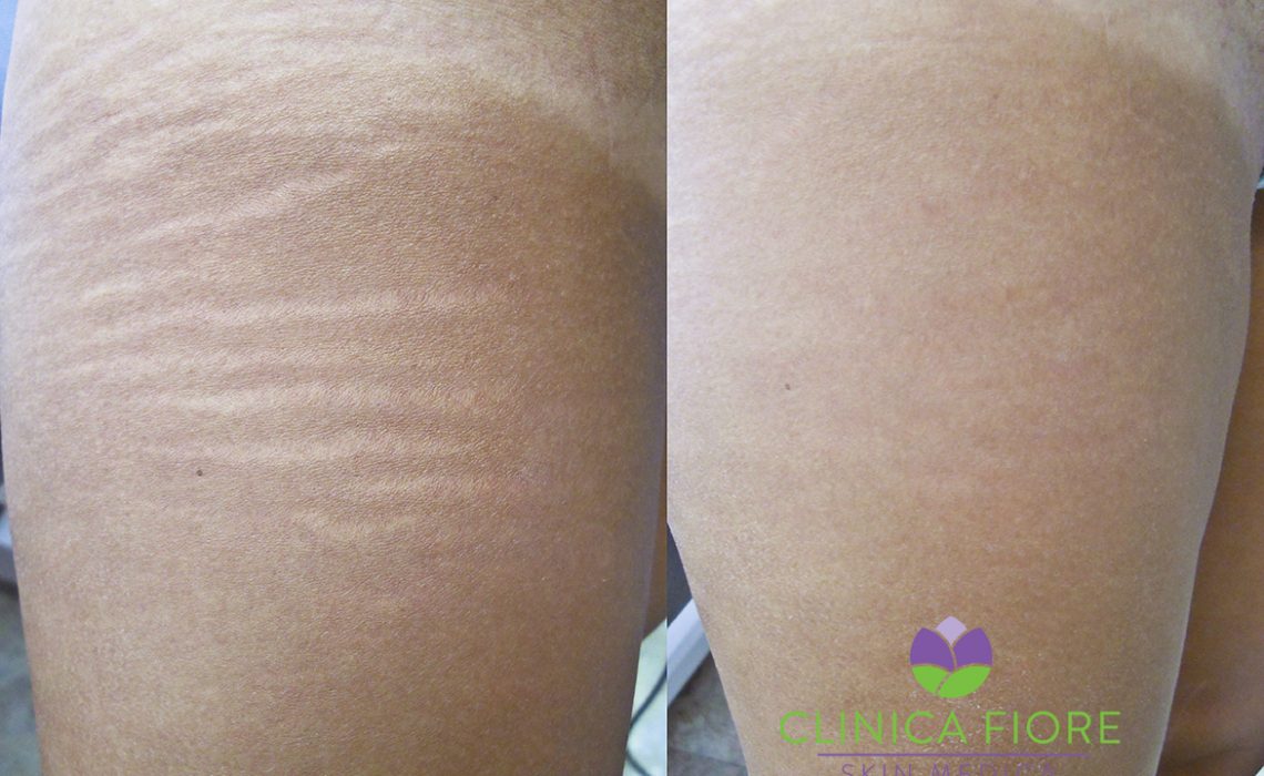 laser stretch mark removal