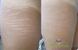 laser stretch mark removal