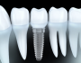 dental implants Delray Beach