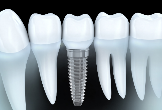 dental implants Delray Beach