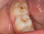 5 Telltale Signs You May Need Tooth Fillings